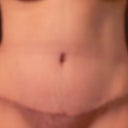 4 Week Post-Op Front