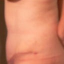 4 Week Post-Op side (looking very swollen up top and below belly button.