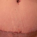4 Week Post-Op TT incision