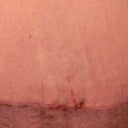 4 Week Post-Op Up Close TT incision. Little scab there, but not infected.