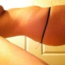 SIDE VIEW... 6/26 BEFORE SURGERY