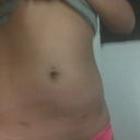 2 days post op. Definitely flatter but still signs of a small buldge...hoping that flattens out over the next few days. You can also see my 2 scars