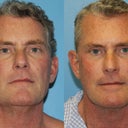 Exilis Face Male