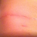 Other side of incision