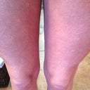 Bumps are all over my legs too :(
