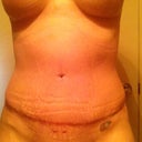5.5 week po incision