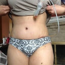 Belly bottom 1 week still swollen looks lopsided .