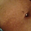 BEFORE Treatment: Up close of my stomach.  You can see that my natural skin color is brown and the clusters are a cream/ whitish color.