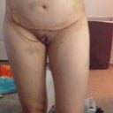 Front view 3 days post op.