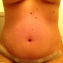 2 weeks post op - dr says Im still dealing with swelling - good news to me since  already pleased.