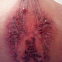 6.22.12  17 hours after procedure number 3
