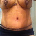 tummy 15 days post op.  the black is actually the glue he uses... my bb had the glue and tape removed this morning! still swollen but i'm so happy
