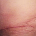 Left Scar