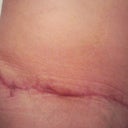 RT Scar..this one is the worst..had spitting stitches.. :(