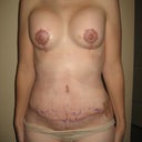 15 days Postop