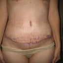 15 days Postop