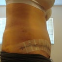 side 7 days post-op very swollen