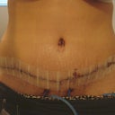 7 days post op Too BAD Dr. couldnt remove all stretch marks