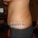 2 weeks post op SUCKS I still cant wear a bikini I have lots of stretch marks :-(