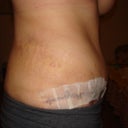 2 weeks post op right side healing faster I guess I think tummy looks good so far