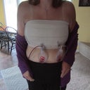 Dressing/Wrapped up Day 1 Post-Op
