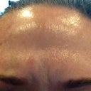 9 days post Botox, pulling eyebrows together