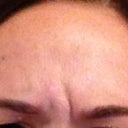 5 days post botox, pulling eyebrows together