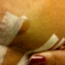 The blister