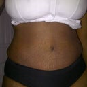 Swelling here, but because of the breast reduction.