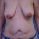 Pre-op photo by my nurse.