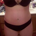 13 days post op from original surgery and 9 days post op from emergency surgery