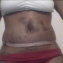 The day drains came out front view 8 days PO bruising and swelling.