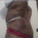 Day 8 PO when drains came out side view bruising and swelling.