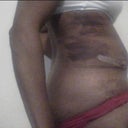 Day 8 PO with drains out other sideview lots of bruising and swelling. A little bent backwards trying to take picture on web cam.