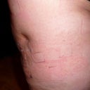 09-25-08 Day 1 The little dent on the right leg after the procedure on the outer thighs