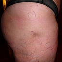 09-25-08 Day 1 The little dent on the right leg after the procedure on the outer thighs