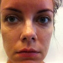Before - Day of Surgery