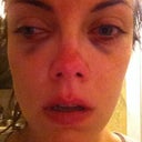 Right after I got home - about an hour after surgery.  The bruising is a'comin' (No, that's not a crying face...that's the results of a drippy nose!  Don't forget the tissues!).