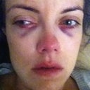 Oh, the lighting is just wonderful on this one.  It does show the bruising better (about 4 hours after surgery).
