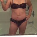 After TT. 2 weeks post op. Belly button is still healing, red marks near BB are from blisters.