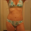 Revision 2 weeks post-op. No more vertical scar!