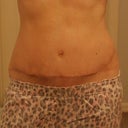 Revision incision is a little swollen but I love that the vertical is gone!