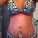 3 days after. swollen and looking forward to seeing what the vertical looks like under the tape.  love that I have something to fill up the top of my swim suit though.  280cc high profile silicone