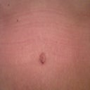 Belly button close up 6 weeks.