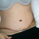 4 days post-op. One drain gone... one to go!