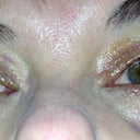 Day 7 - sutures under the lower lashes are really healing well