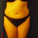 before surgery/ sorry about the wrong date on the picstures I dont know how to change it.