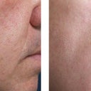 Skin Resurfacing