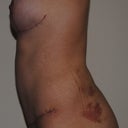 5 weeks post-op
