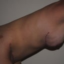 5 weeks post-op
